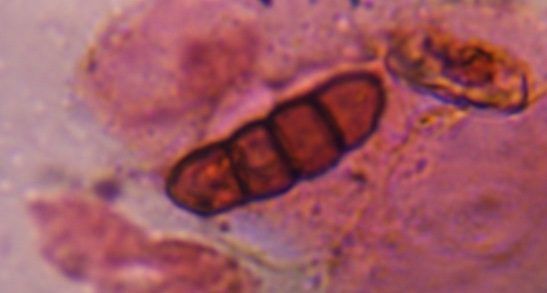 Dematiaceous ascospore mold spore under a microscope, verified by PollyMap