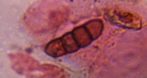 Dematiaceous ascospore mold spore under a microscope, verified by PollyMap